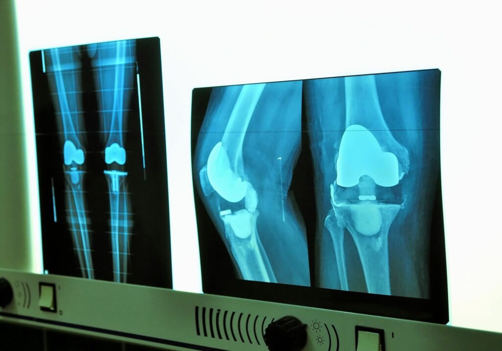 x-rays of knee arthroplasty