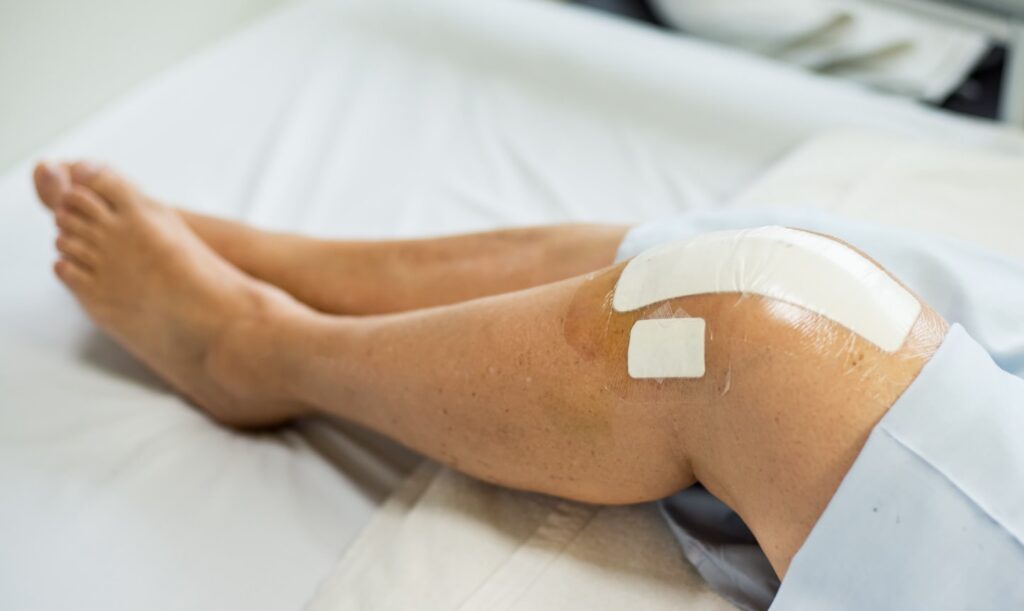 Understanding the Costs of Knee Arthroplasty Surgery