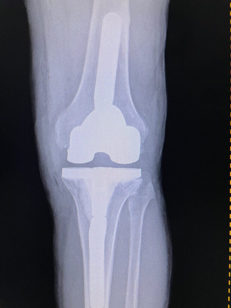 x-ray of total knee replacement