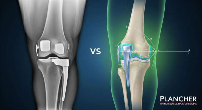 Robotic vs. Traditional Knee Replacement: What's Better for You?