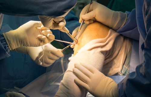 Preparation tendon For ACLR (Arthroscopic ACL reconstruction)